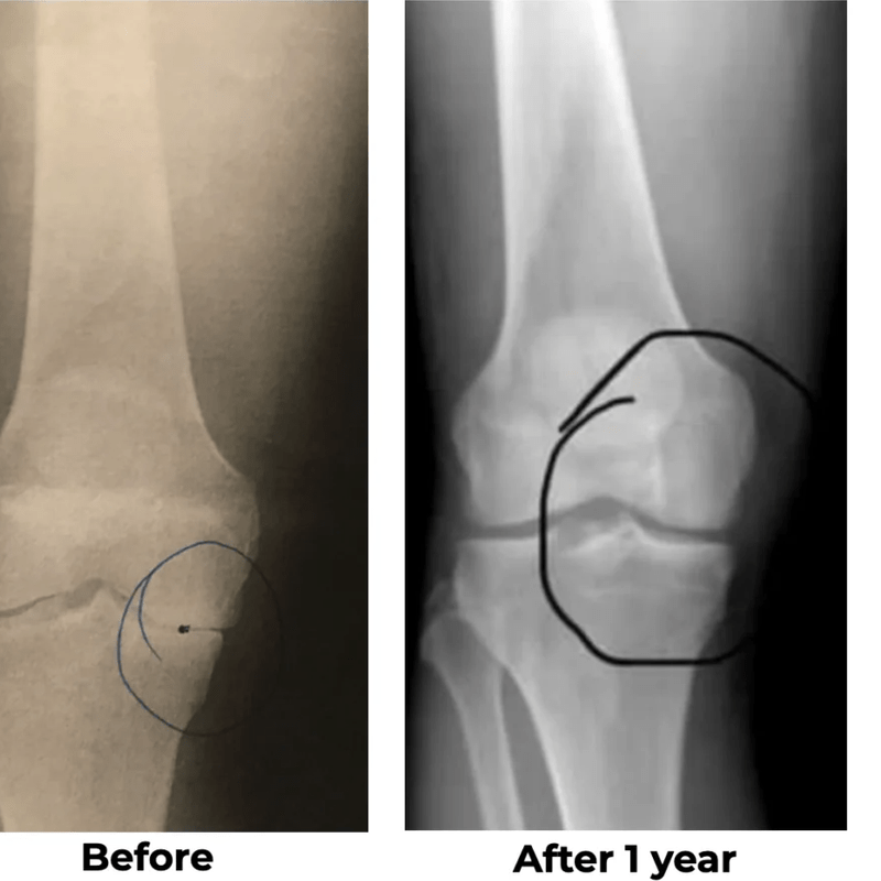 Exosome Injection – 4