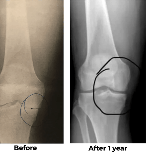 Exosome Injection – 1